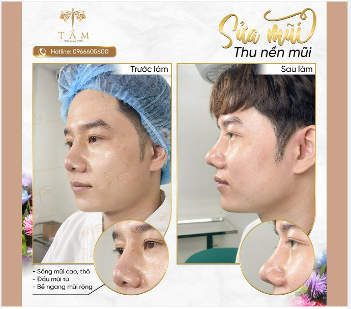 Một ca sửa mũi cho anh khách nam đã nâng mũi từ trước tuy nhiên dáng mũi khá thô, cánh mũi to và đầu mũi tù, thiếu độ nhô.