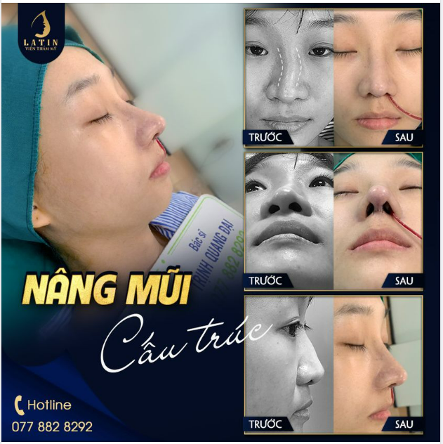 NÂNG MŨI CẤU TRÚC GIÚP BẠN THAY ĐỔI NHƯ THẾ NÀO