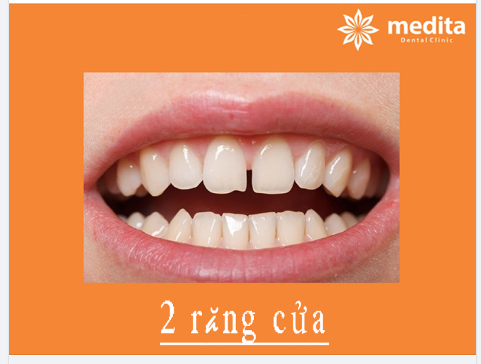 NIỀNG 2 RĂNG CỬA ĐƯỢC KHÔNG?