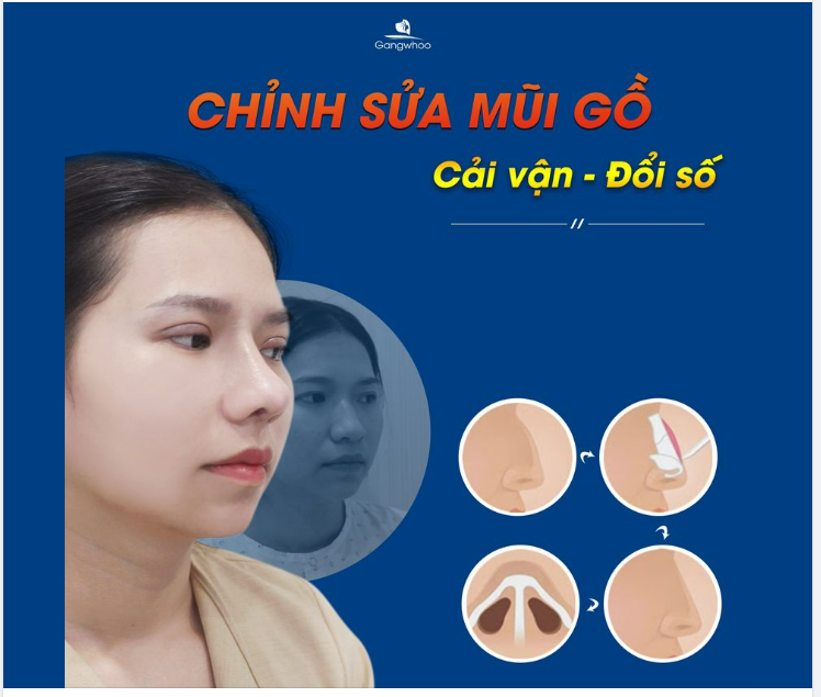 CHỈNH SỬA MŨI GỒ - CẢI VẬN ĐỔI SỐ LÀ THẬT!