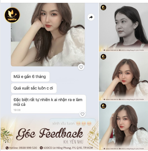 Đẹp tự nhiên nhưng không tự nhiên mà đẹp. Feedback chân thật của bạn Yến Như sau 6 tháng thực hiện dịch vụ nâng mũi cấu trúc đặt sụn Surgiform tại Bác sĩ Hoạt!