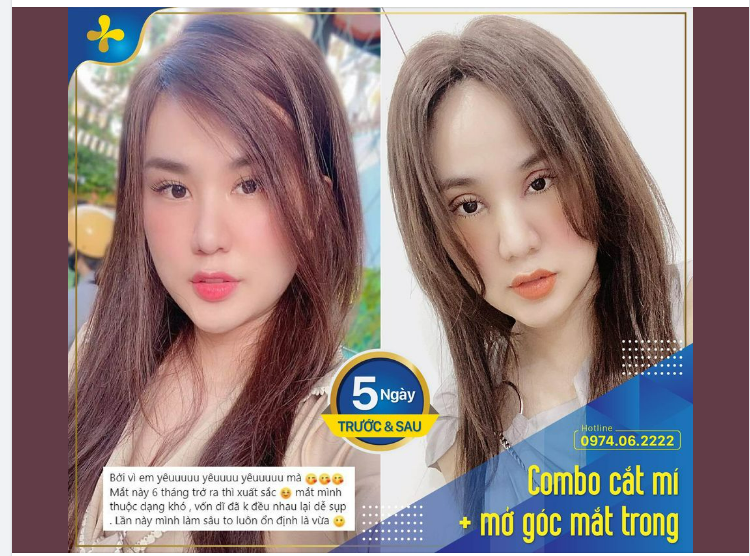 Review và kết quả thực tế sau 5 ngày cắt mí + mở góc mắt trong tại Dr.Tống Hải