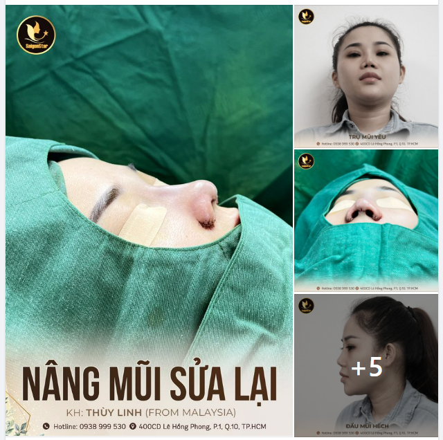 KHUYẾT CÁNH MŨI – TRỤ MŨI YẾU PHƯƠNG PHÁP NÀO TỐI ƯU?