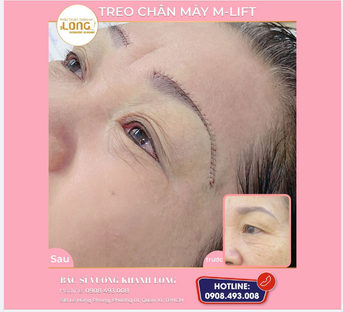 PHÁT HIỆN MỘT CA SAU KHI TREO CHÂN MÀY TẠI BÁC SĨ LONG  “BẤT ỔN ”