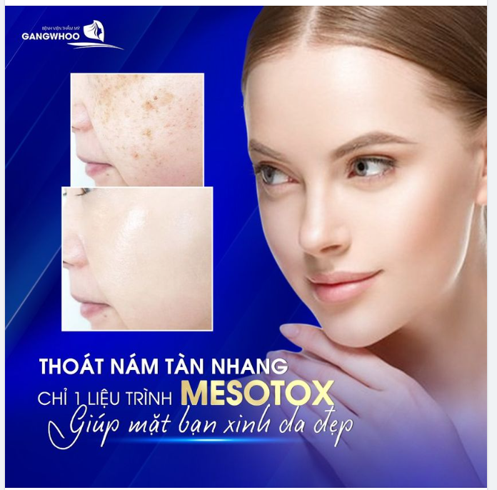 THOÁT NÁM TÀN NHANG CHỈ 1 LIỆU TRÌNH MESOTOX GIÚP MẶT BẠN XINH DA BẠN ĐẸP