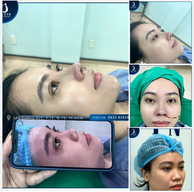 Mũi cấu trúc form cao tự nhiên theo yêu cầu khách hàng