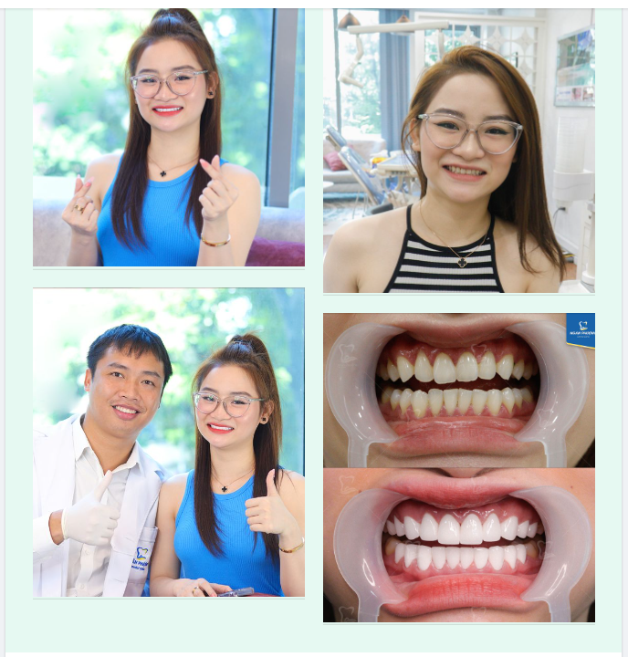 RĂNG SỨ BỀN ĐẸP - NỤ CƯỜI RẠNG RỠ VƯỢT THỜI GIAN