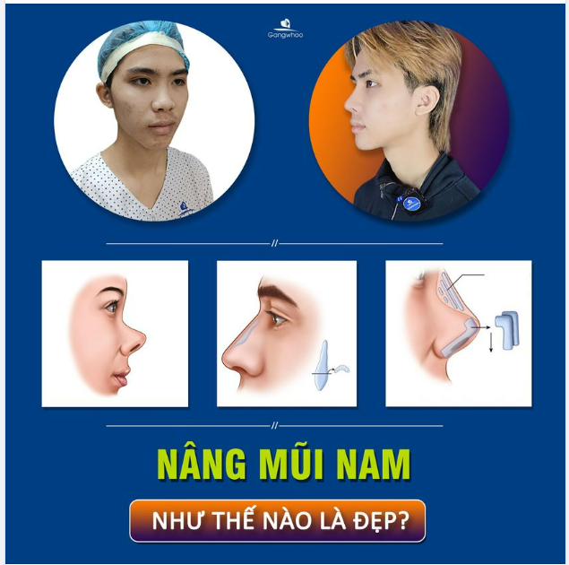 NÂNG MŨI NAM NHƯ THẾ NÀO LÀ ĐẸP?