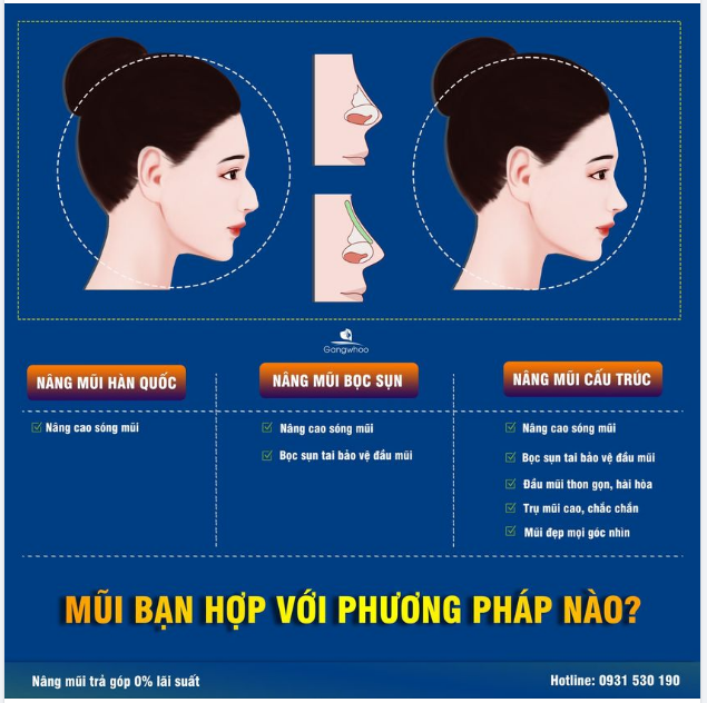NÂNG MŨI NHƯNG MŨI BẠN HỢP VỚI PHƯƠNG PHÁP NÀO?