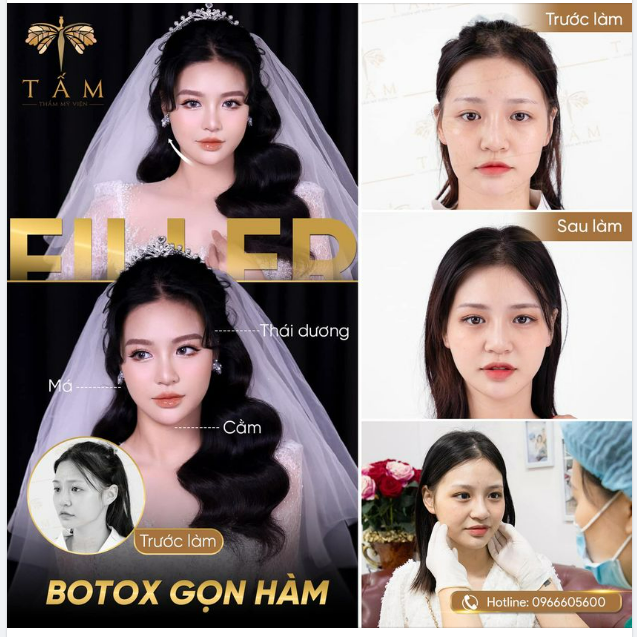 MẶT VLINE THON GỌN ĐẸP TỰ NHIÊN NHƯNG KHÔNG TỰ NHIÊN MÀ ĐẸP