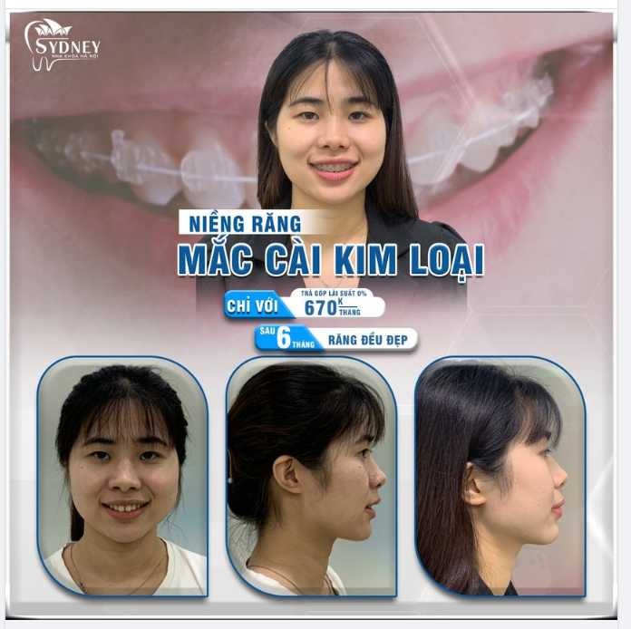Ưu điểm của niềng răng kim loại
