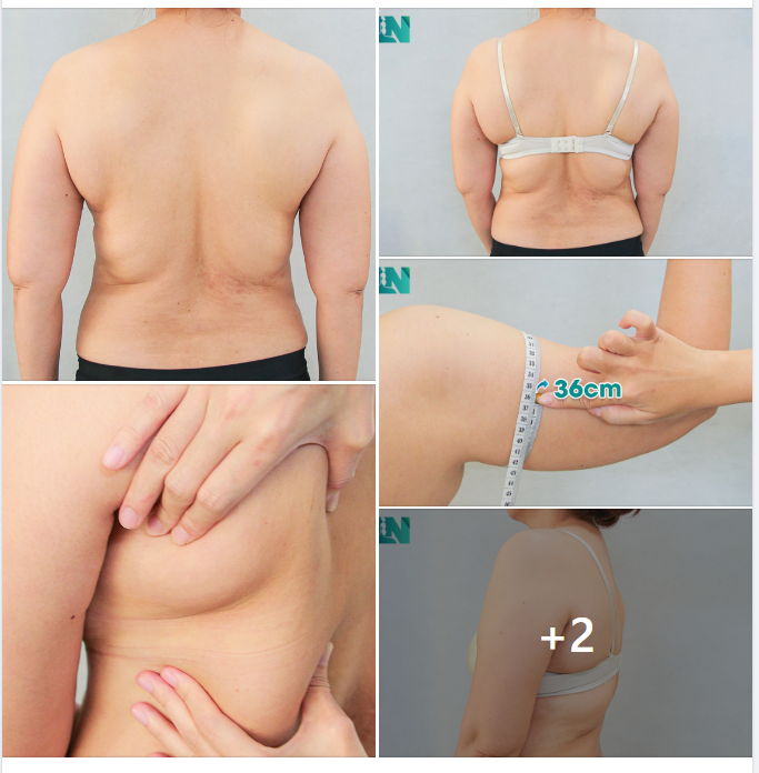 CHỊ KH 54 TUỔI, CHỌN GIẢI PHÁP GIẢM MỠ AN TOÀN. 