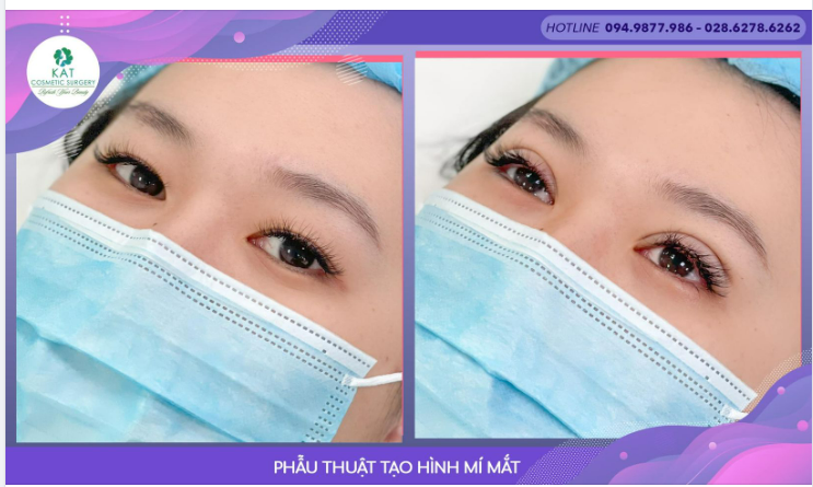 “Đôi mắt hai mí chỉ trong tích tắc​​​​​​​“