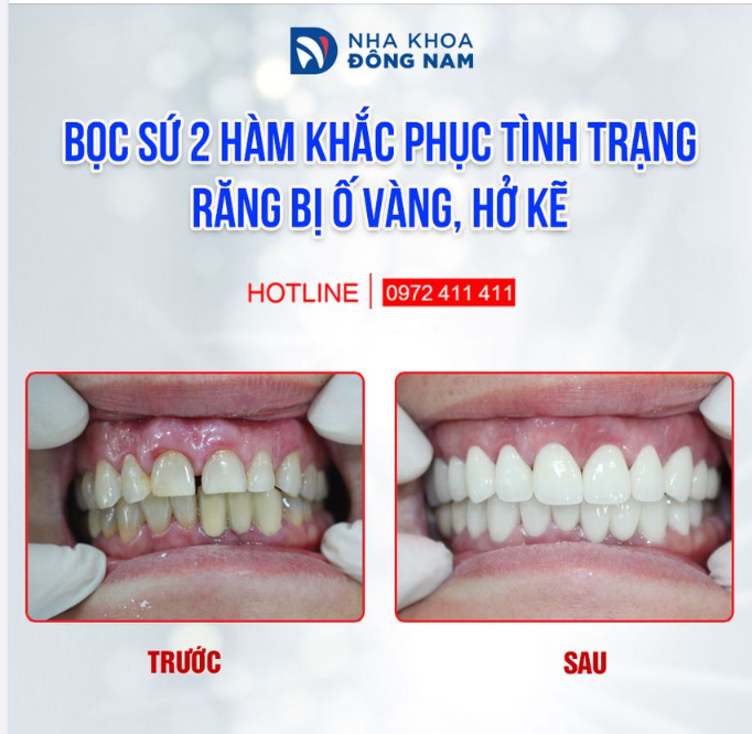 Không phải cứ làm răng sứ là sẽ đẹp mà cần phải có sự tính toán, nghiên cứu về hình dáng, màu răng với sự tương quan giữa răng - cung hàm - môi - nướu