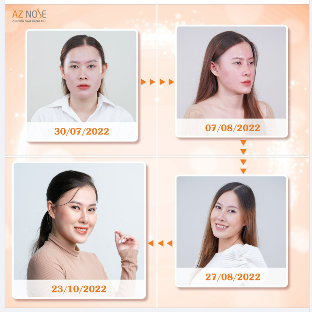 NHAN SẮC THĂNG HẠNG NHỜ THAY ĐỔI DÁNG MŨI