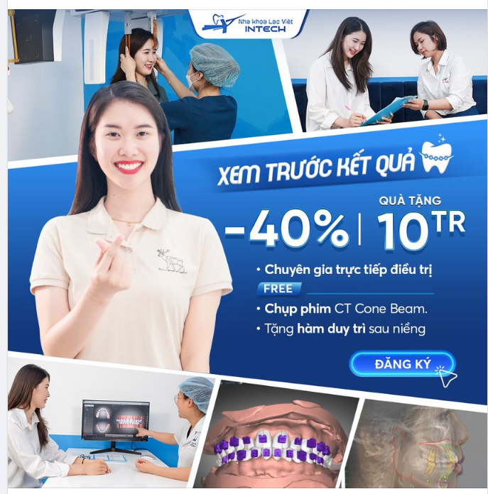 XEM TRƯỚC KẾT QUẢ NIỀNG RĂNG MIỄN PHÍ