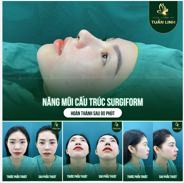90 phút sở hữu dáng mũi mới tuyệt đẹp