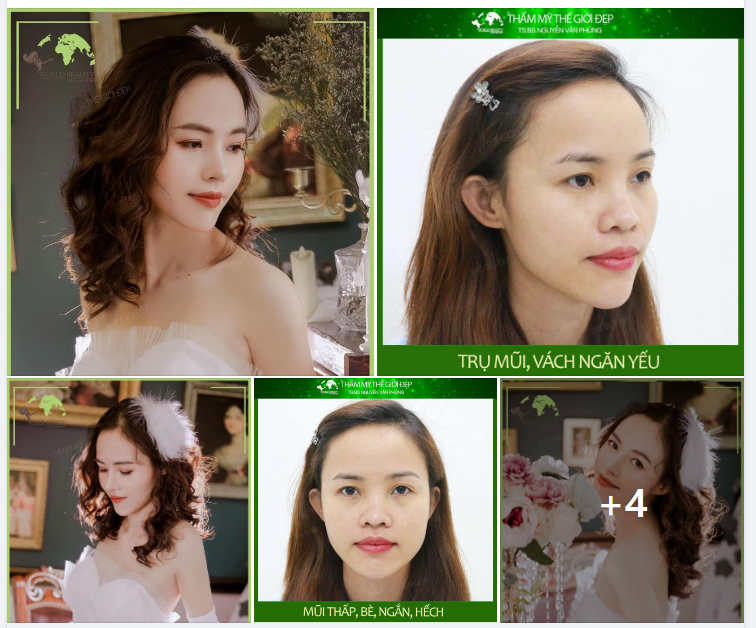 LỘT XÁC TOÀN DIỆN dung mạo chỉ sau ph.ẫu th.uật N.âng mũi cho quý Cô đến từ Mộc Hóa!