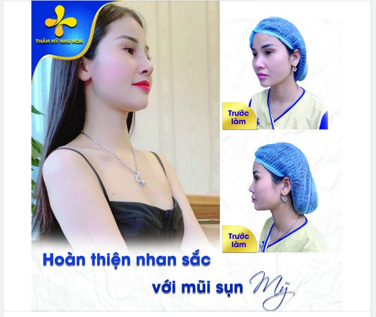 Khách hàng sau khi đến với cơ sở nâng mũi, điều mà họ quan tâm chính là dáng mũi thon gọn, thanh tú, tự nhiên.