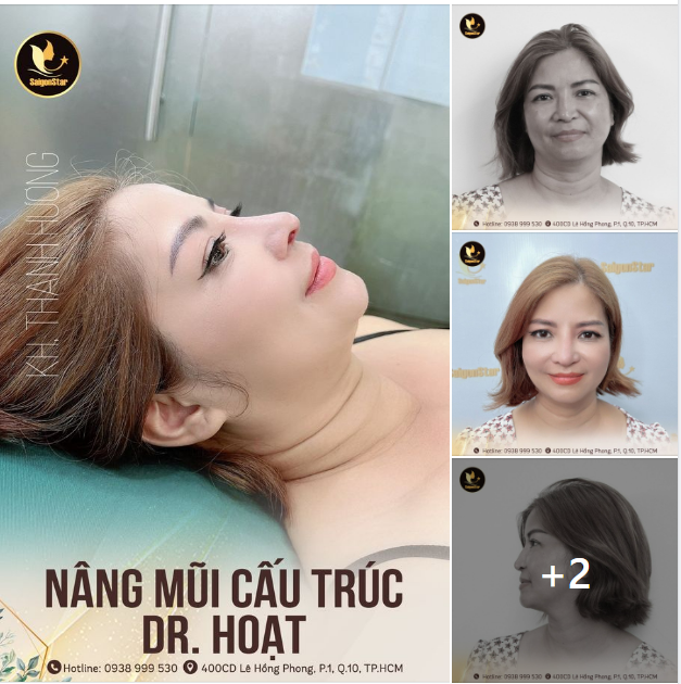 NÂNG MŨI CẤU TRÚC DR. HOẠT – TÁI TẠO MŨI LỆCH