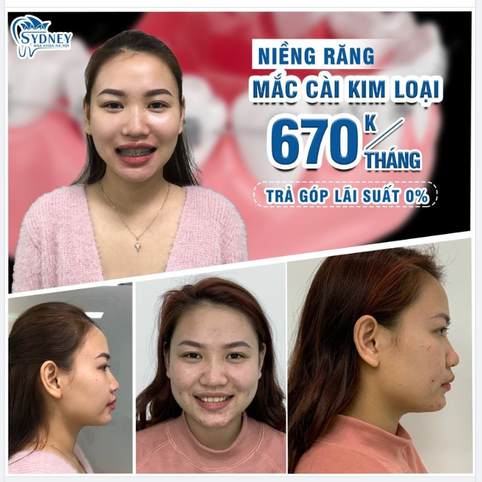 Niềng răng mắc cài kim loại hỗ trợ trả góp 0%