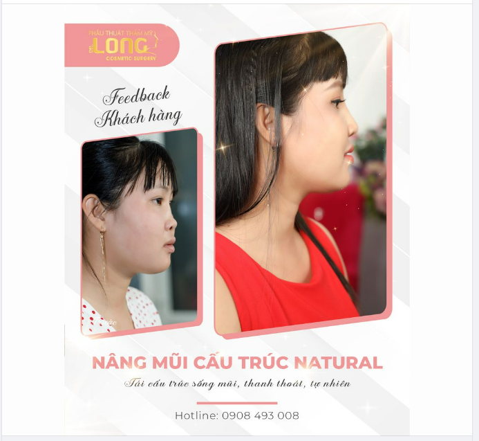 MŨI BIẾN CHỨNG SAU KHI CHỈNH SỬA…CÓ ĐẸP TỰ NHIÊN ĐƯỢC KHÔNG?