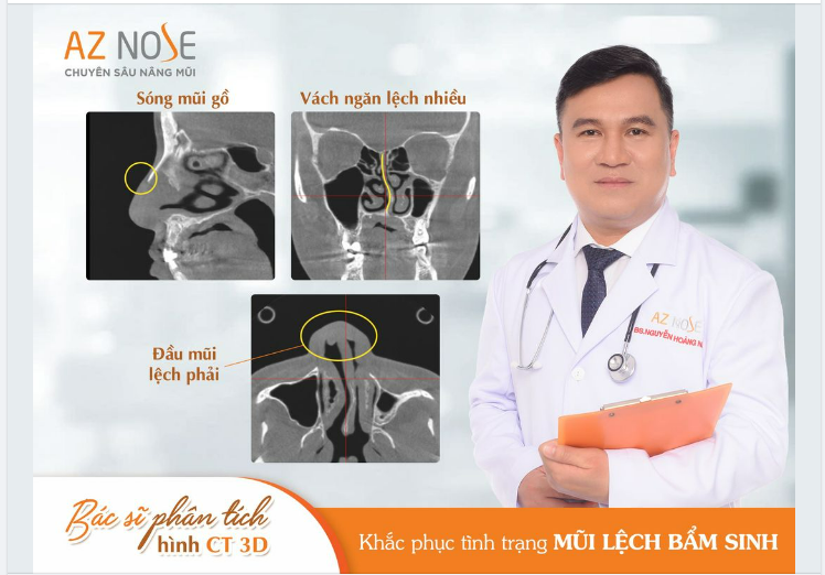 Khắc phục mũi lệch - gồ cho khách hàng Lâm Đồng