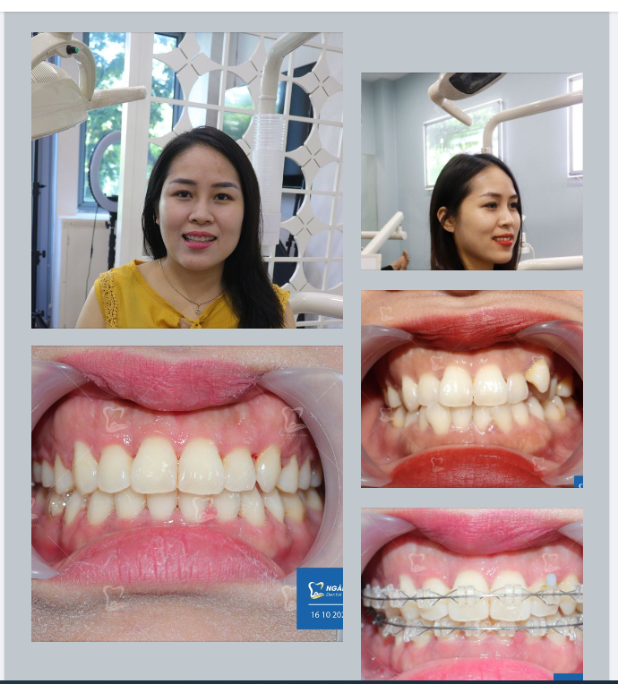 Ai bảo cứ qua tuổi 20 thì không thể niềng răng đều đẹp?