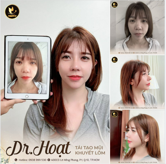 NÂNG MŨI 1 LẦN THÁO SỤN DO VIÊM KHUYẾT LÕM ĐẦU MŨI SÓNG MŨI THẤP