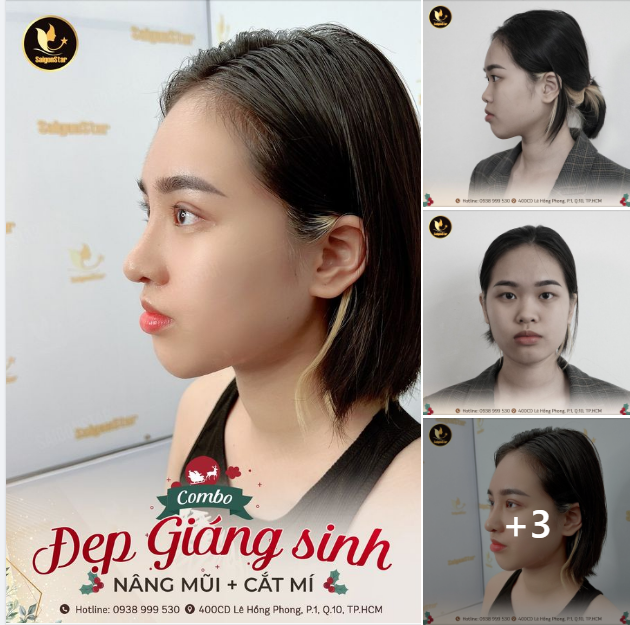 COMBO ĐẸP GIÁNG SINH: NÂNG MŨI + CẮT MÍ
