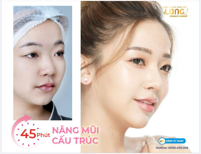 GIÁ TRỊ SAU MỖI LẦN NÂNG MŨI