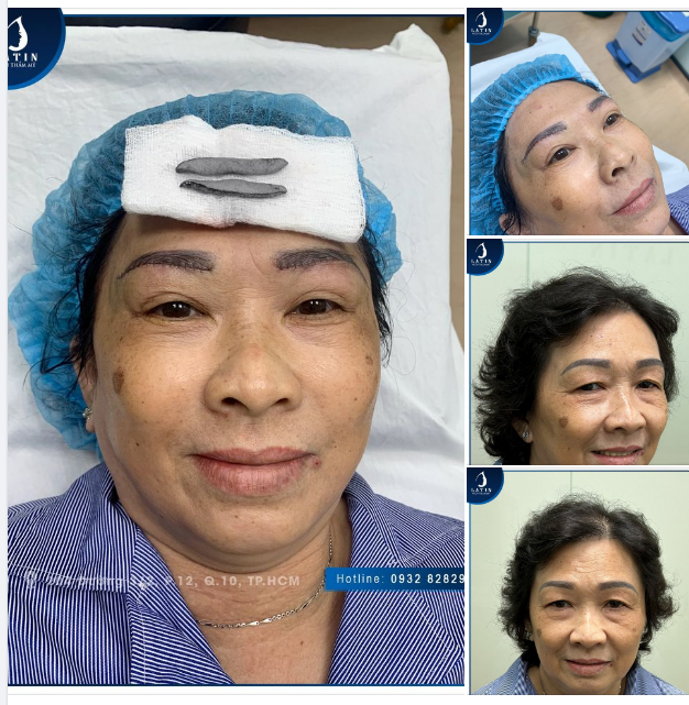 NÂNG CUNG MÀY ĐA TẦNG - TRẺ HÓA DA VÙNG MẮT