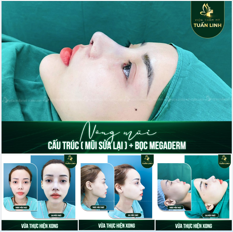 Sống mũi đã từng sửa cách đây 7 năm nhưng không cải thiện được nhiều ... cô ấy đã lựa chọn