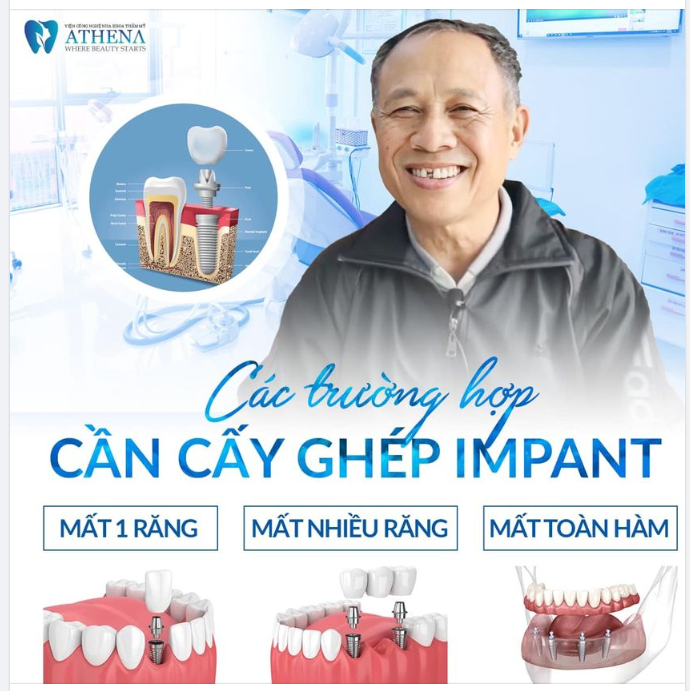 NHỮNG TRƯỜNG HỢP NÀO NÊN CẤY GHÉP IMPLANT?
