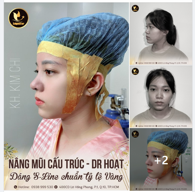 NÂNG MŨI CẤU TRÚC DR. HOẠT DÁNG MŨI S-LINE CHUẨN TỶ LỆ VÀNG
