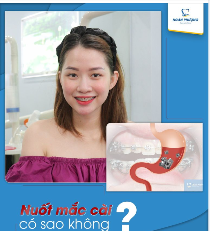 NUỐT MẮC CÀI CÓ LÀM SAO KHÔNG?