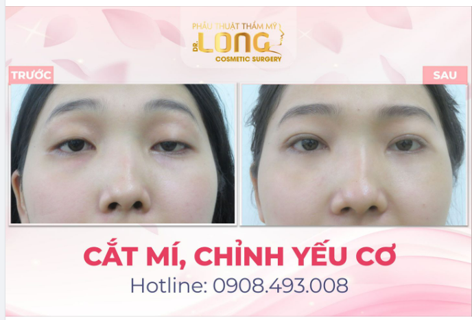 Mời cả nhà vào xem ngay kết quả của bạn khách sau khi chỉnh mí yếu cơ do bác sĩ Long thực hiện.
