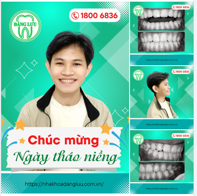 24 tháng niềng răng mắc cài