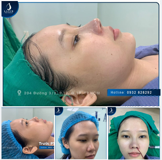 MŨI BÁN CẤU TRÚC SỤN TAI - TÔ ĐIỂM NÉT ĐẸP DỊU DÀNG