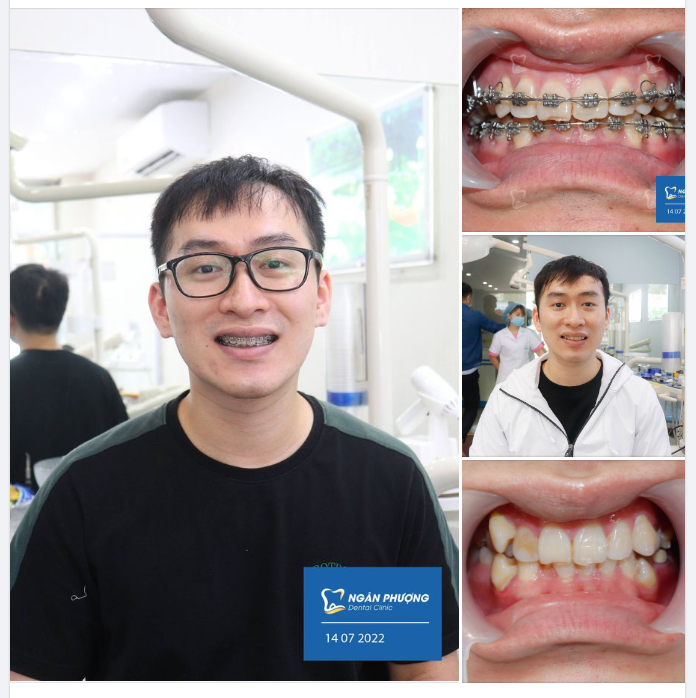 Răng khấp khểnh thì niềng trong bao lâu?