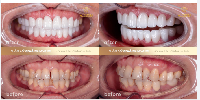 HOÀN HẢO TỪNG MILLIMET LÀ TIÊU CHÍ HÀNG ĐẦU CỦA THẨM MỸ RĂNG SỨ TẠI WIN SMILE