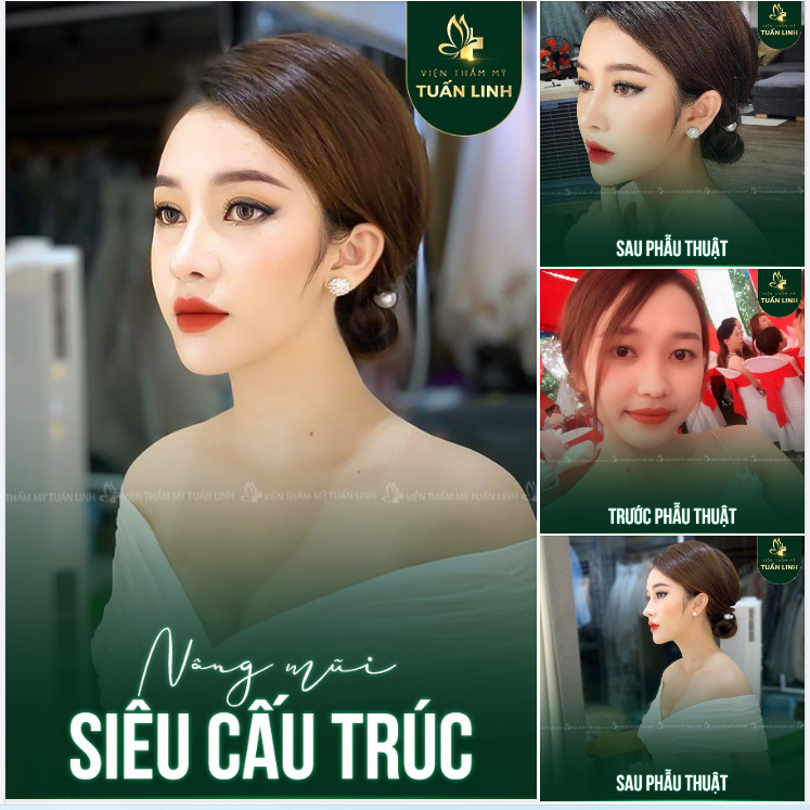 Kỹ thuật nâng mũi siêu cấu trúc sẽ giúp khắc phục tối đa các khuyết điểm mũi. Đặc biệt giúp nâng cao sống mũi và kéo dài đầu mũi hiệu quả.