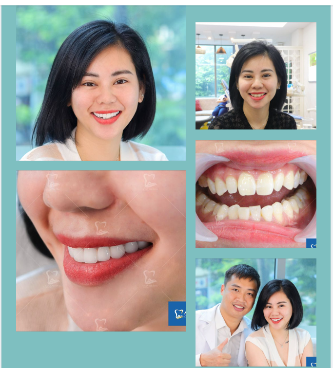 Đâu ai biết được chữ ngờ Răng sứ tuyệt đẹp còn chần chờ chi?