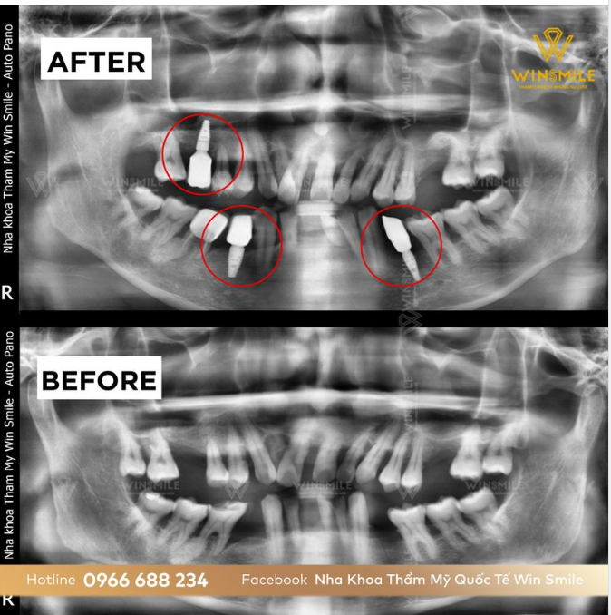 TUỔI THỌ CỦA RĂNG TRỒNG IMPLANT KÉO DÀI BAO LÂU?