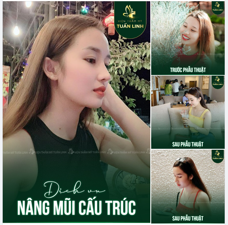 NÂNG MŨI CẤU TRÚC ĐẸP HƠN MONG ĐỢI