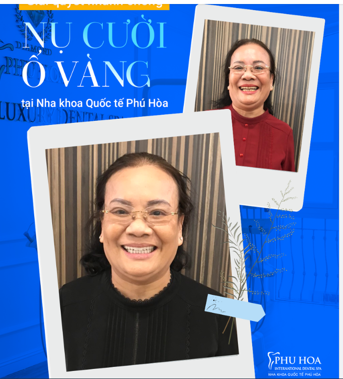GIẢI QUYẾT NHANH CHÓNG NỤ CƯỜI Ố VÀNG TẠI NHA KHOA QUỐC TẾ PHÚ HÒA