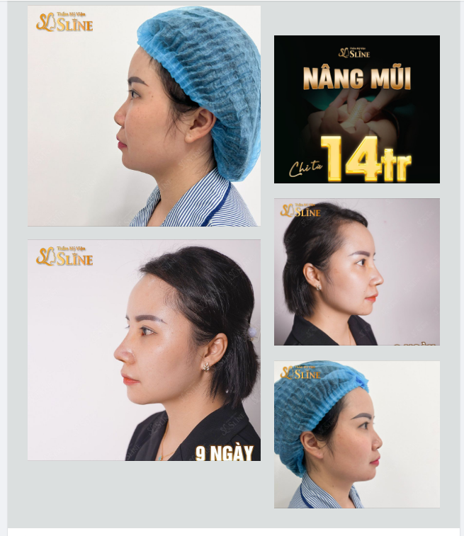 Nâng mũi sau 9 ngày sẽ như thế nào?