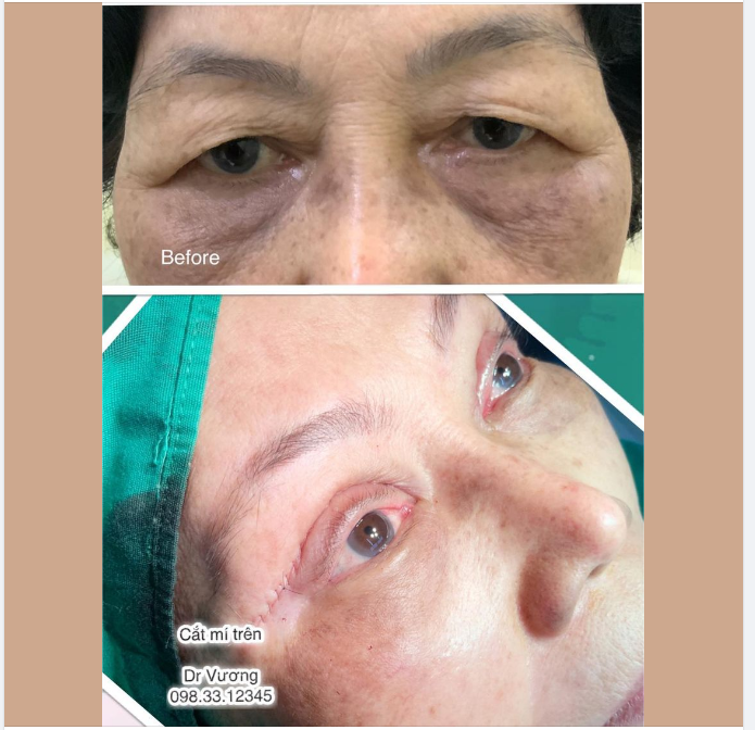 Khách hàng cắt mí