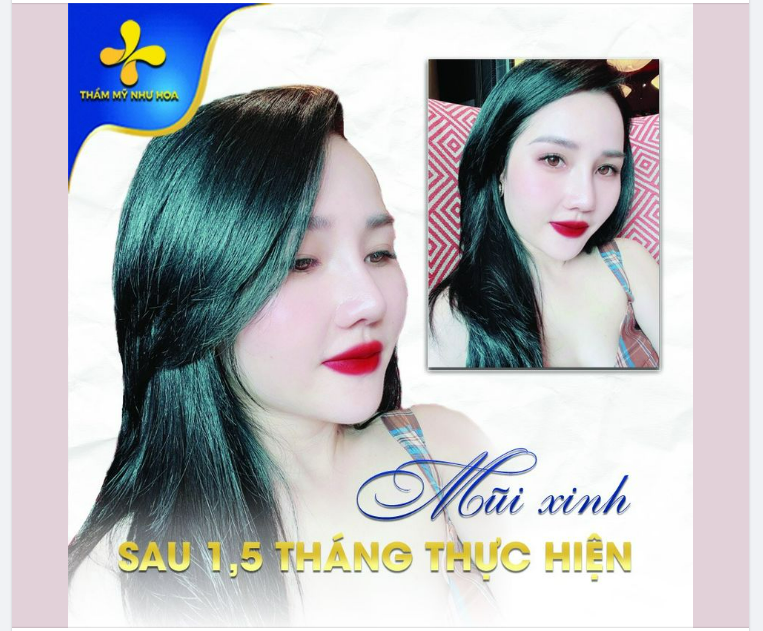 MŨI XINH SAU 1,5 THÁNG THỰC HIỆN BỞI DR TỐNG HẢI
