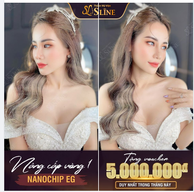 Nâng ngực hôm nay  tặng ngay voucher 5.000.000VNĐ